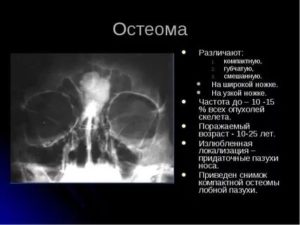 Остеома лобной пазухи лечение