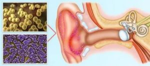 Синегнойная палочка в ухе лечение
