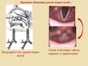 Спазм дыхательных путей причины