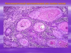 Инвазивный плоскоклеточный ороговевающий рак