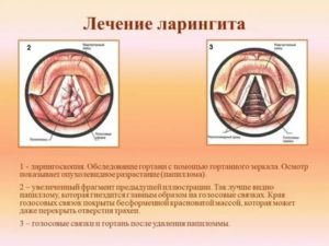 Лечение голосовых связок лекарствами