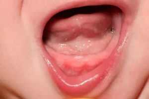 Красное горло при прорезывании зубов у детей