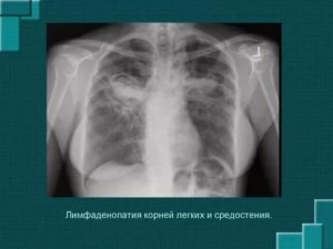 Увеличение лимфоузлов в легких причины
