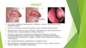 Раздражение слизистой носа лечение