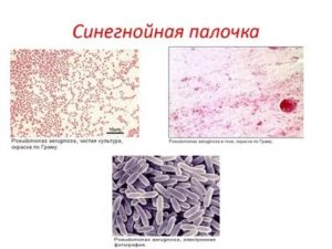 Синегнойная палочка у детей комаровский видео