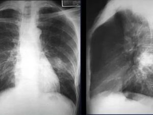 Очаговая пневмония рентген