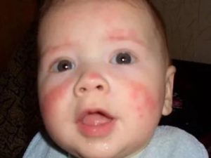 Аллергия на физраствор у ребенка