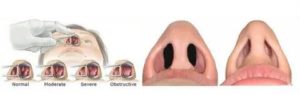 Гиперплазия слизистой носовых ходов