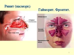 Ринит и гайморит разница