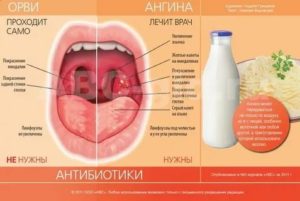 Если ангина долго не проходит