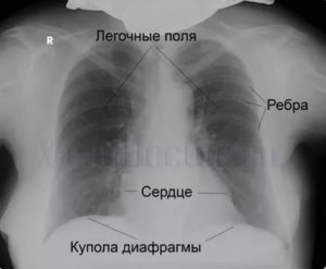 Рентгеновский снимок легких здорового человека