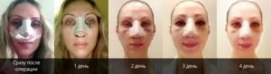 Сколько заживает нос после ринопластики