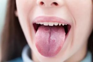 Воспаление ротовой полости и языка лечение