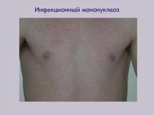 Сыпь при инфекционном мононуклеозе у детей фото