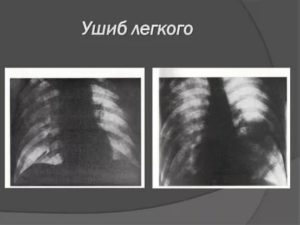 Кровь в легких после травмы