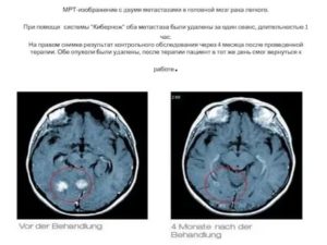 Рак легких с метастазами в головной мозг