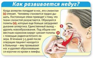 Ребенок тяжело дышит носом но соплей нет