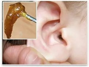 Много серы в ушах у взрослых причины