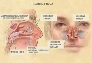 Почему заложена одна ноздря