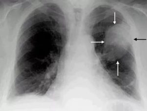 Виден ли рак легких на флюорографии