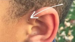 Паразиты в ушах человека симптомы