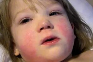 Сыпь при инфекционном мононуклеозе у детей фото