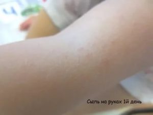 Сыпь при орви у ребенка фото