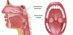 Нужно ли удалять миндалины ребенку