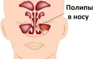 Постоянно не дышит нос что делать