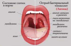 Можно ли мыться при ангине без температуры