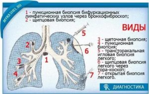 Биопсия легкого последствия