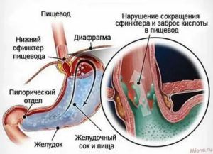 Заброс желудочного сока в горло