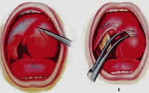 Паратонзиллярный абсцесс лечение после вскрытия