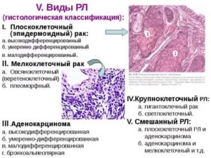 Умеренно дифференцированный плоскоклеточный рак