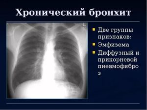 Рентген признаки бронхита