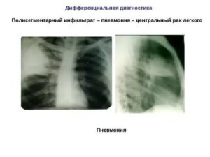 Пневмония и рак легких как отличить