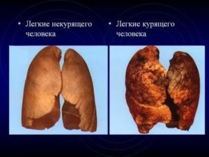 Легкие курящего человека и некурящего