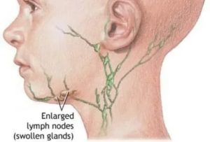 Подчелюстные лимфоузлы увеличены причины лечение