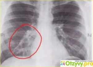 Как выглядит бронхит на рентгеновском снимке
