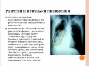 Рентгенологические признаки пневмонии