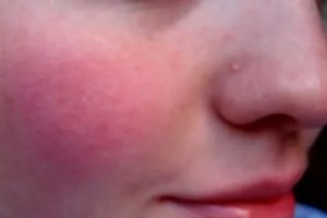 Почему красные щеки у подростка