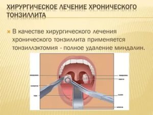 Хронический тонзиллофарингит лечение