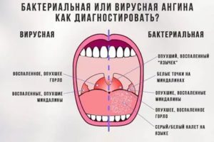 Почему не проходит ангина после антибиотиков