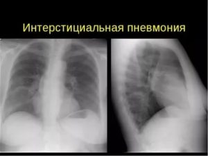 Интерстициальный пневмонит симптомы