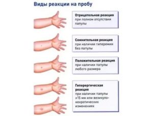 Можно ли делать диаскинтест при кашле