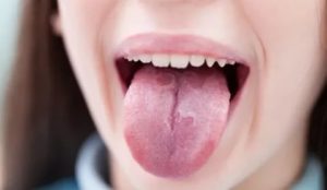 У ребенка обложен язык белым налетом