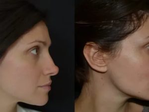 Можно ли изменить форму носа без операции