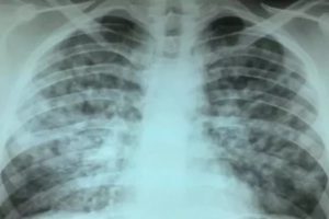 Диссеминированный туберкулез легких в фазе инфильтрации
