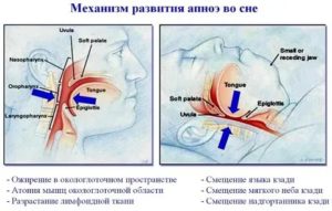 Во время сна останавливается дыхание причины