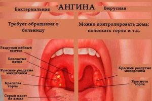 Первые признаки ангины как лечить